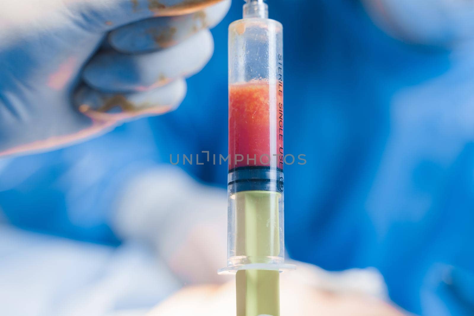 Human fat in a syringe close-up. Liposuction for lipofilling surgery operation. Plastic operation in medical clinic. by Rabizo