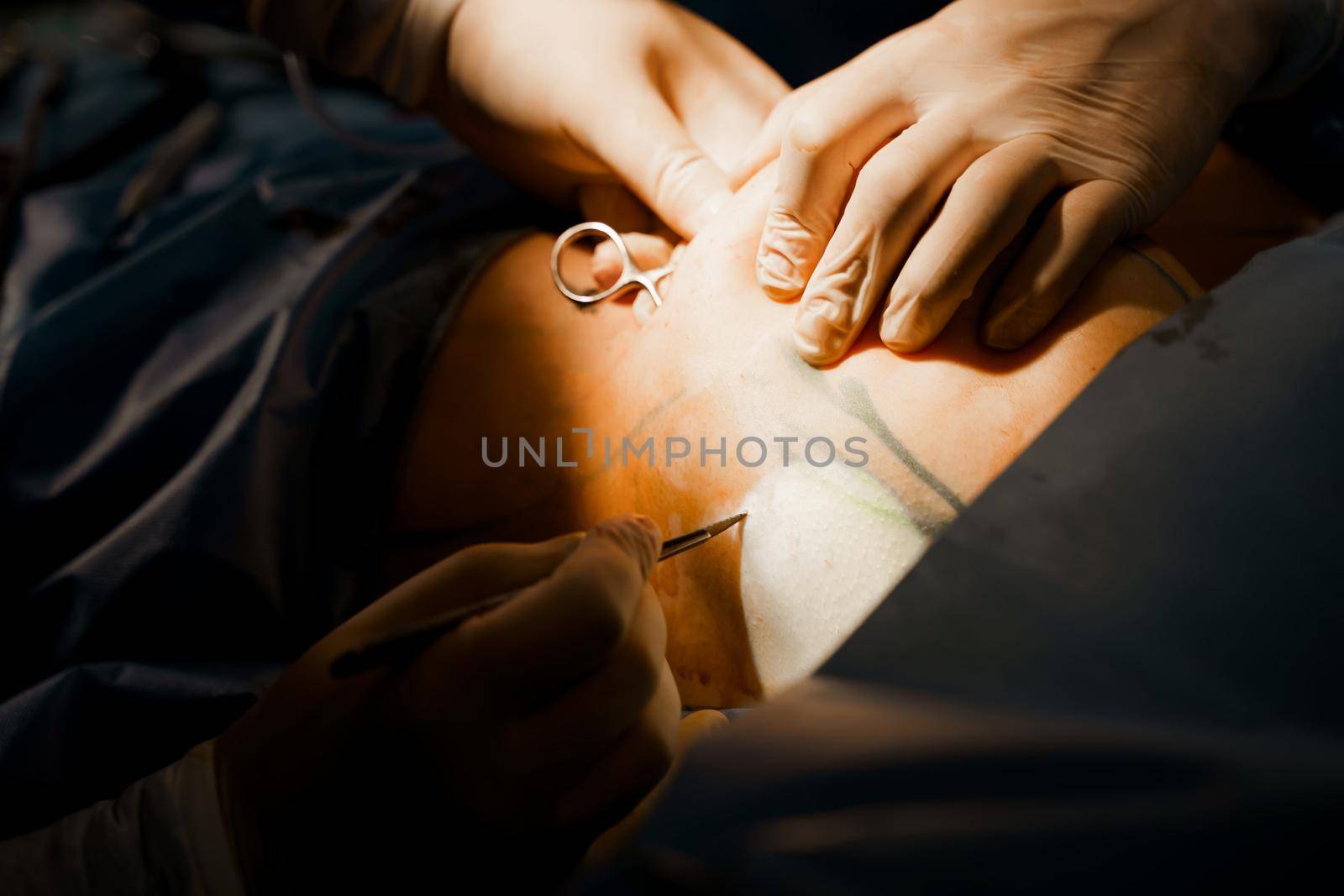 Surgeon surgeon sutures chest of woman after operation. Tits augmentation plastic operation and correction in medical clinic