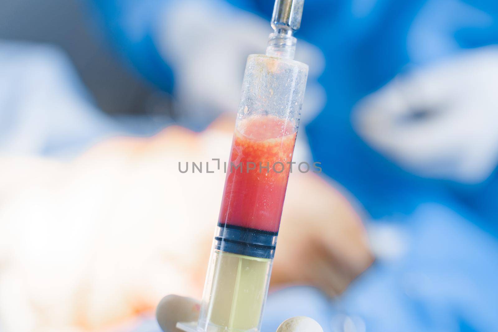 Human fat in a syringe close-up. Liposuction for lipofilling surgery operation. Plastic operation in medical clinic. by Rabizo