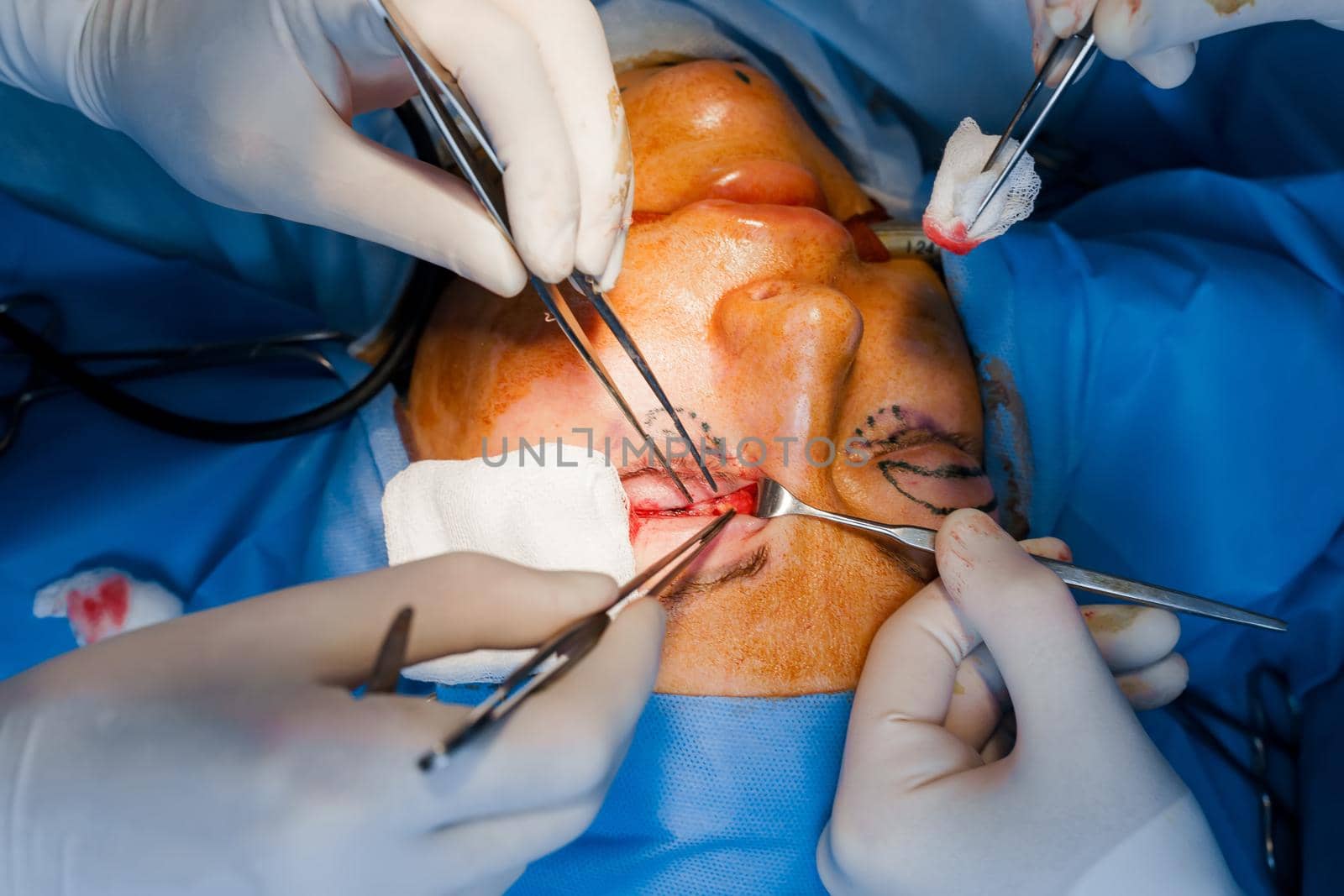 Transconjunctival blepharoplasty. Surgery. Upper blepharoplasty. Surgeon do plastic operation. 2 surgeons removing piece of skin from eyelid. by Rabizo