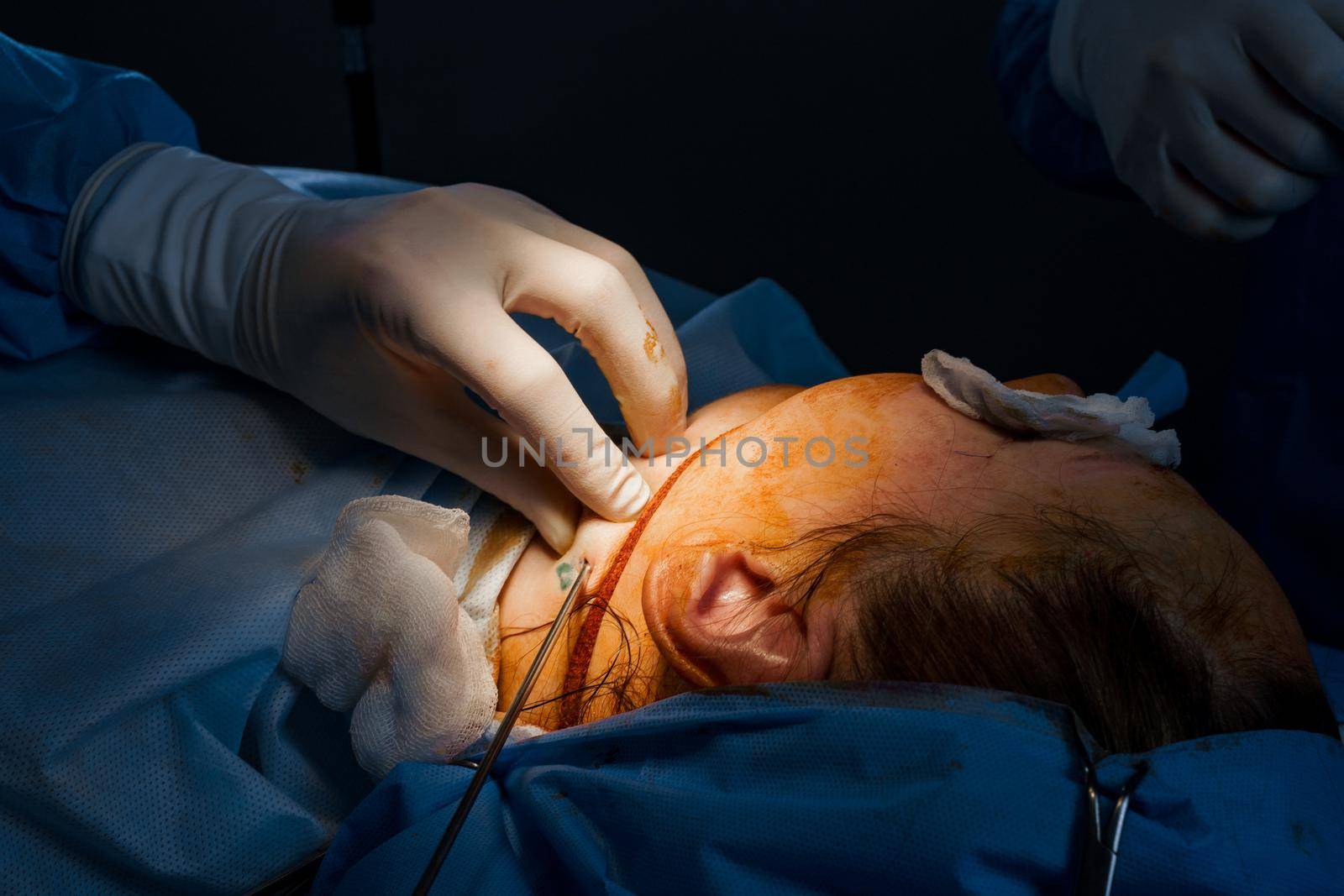 Liposuction of the chin surgery. Pumping out fat in the chin area of a woman. Face shape correction. Cosmetology procedures for aged people. by Rabizo