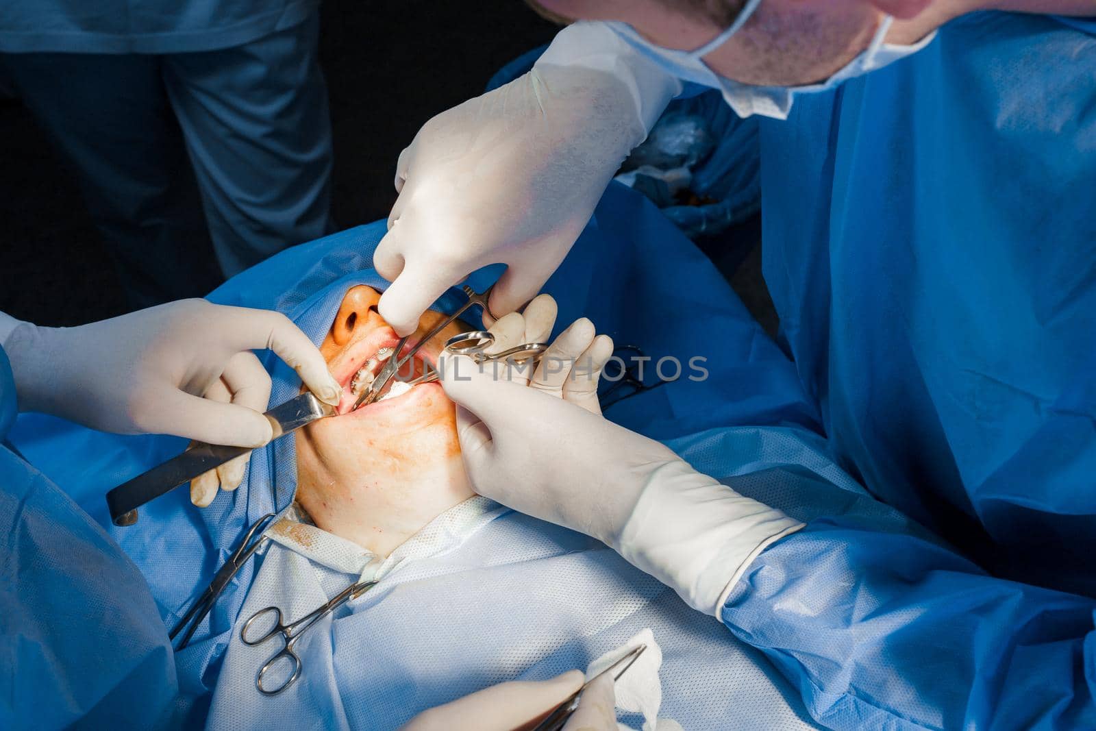 Buccal fat removal. Bisha lumps removal. Plastic surgery in clinic. Plastic surgery operation for modifying face in medical clinic.
