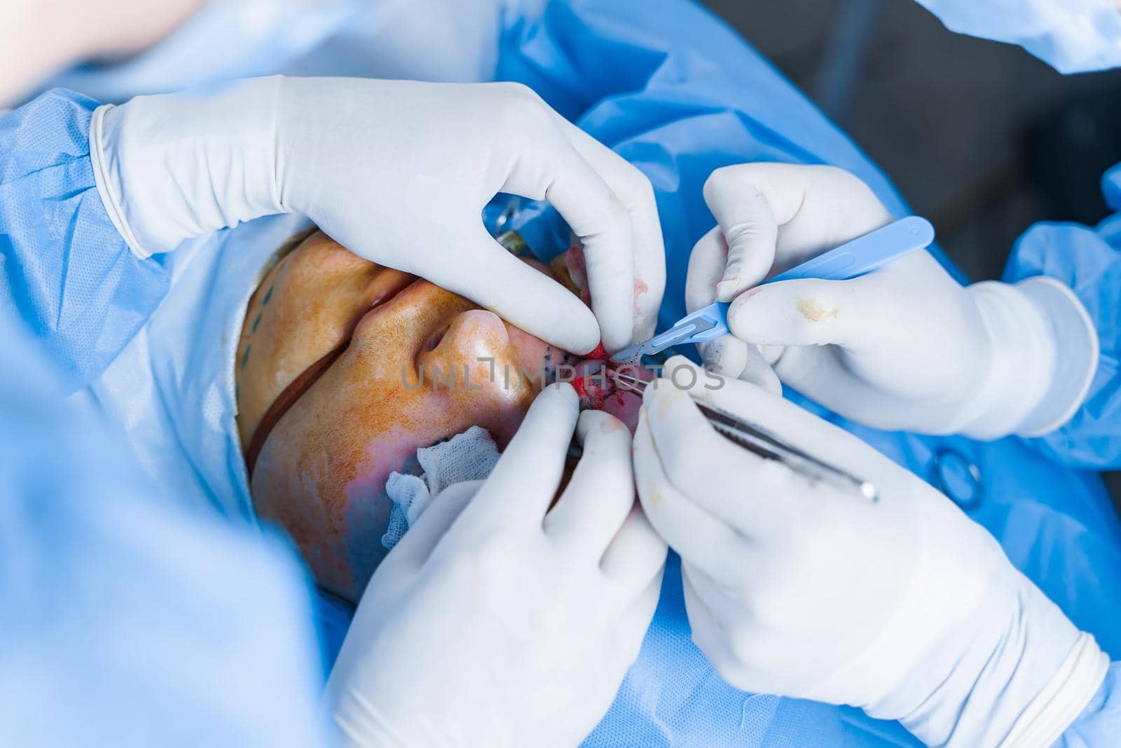 Blepharoplasty plastic surgery operation for modifying the eye region. 2 doctors do plastic cosmetic operation for woman. Surgeon sutures the eyelid.