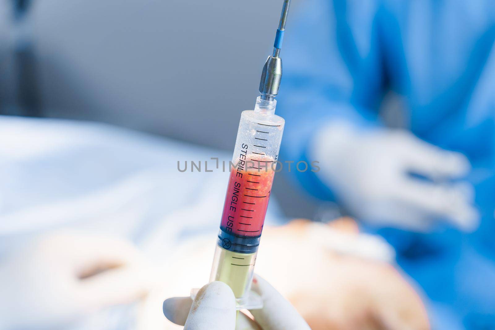 Human fat in a syringe close-up. Liposuction for lipofilling surgery operation. Plastic operation in medical clinic