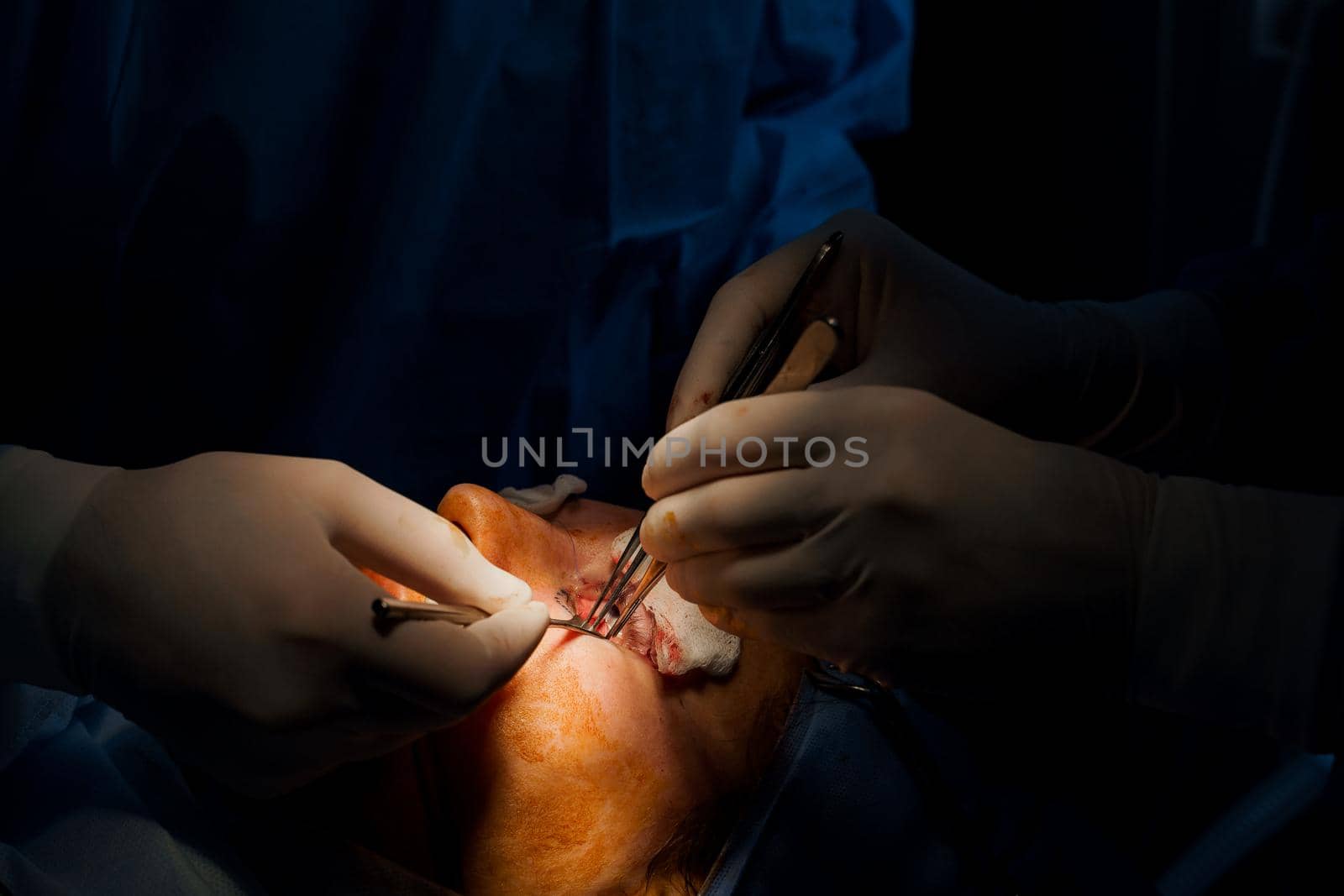 Upper blepharoplasty. Surgeon do plastic operation. 2 surgeons removing piece of skin from eyelid. Transconjunctival blepharoplasty. Surgery by Rabizo