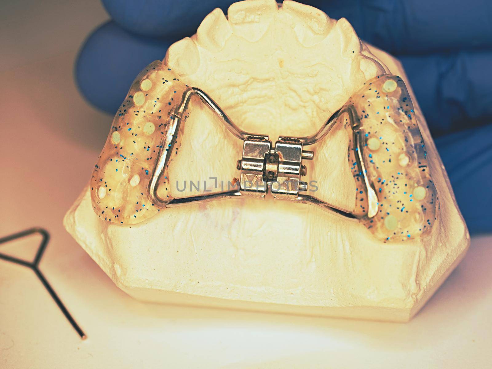 Hyrax braces wear on patient teeth gypsum model.  Dentist check exact setting before putting it on the patient upper palate.