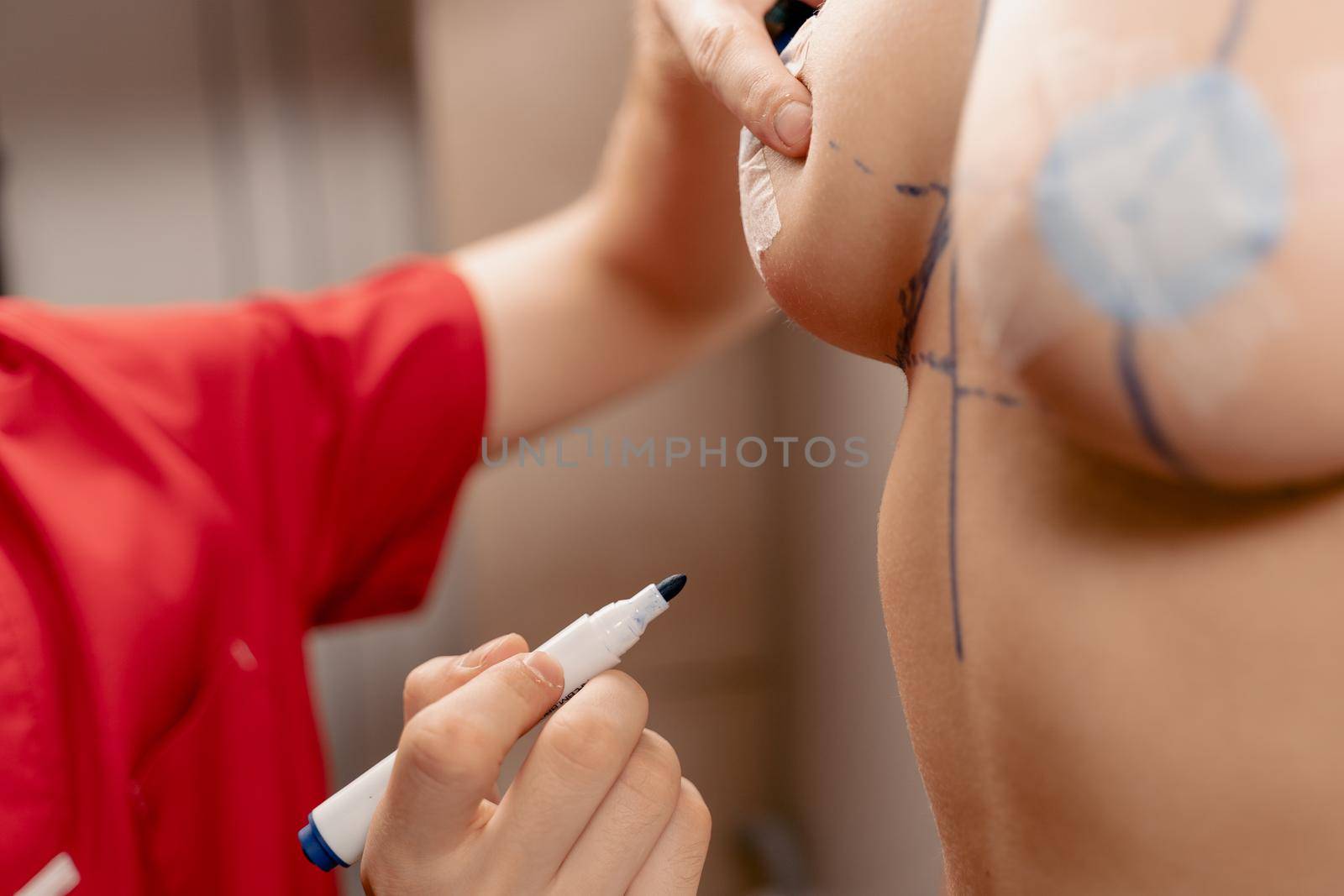 Drawing a marking line on the chest of a young girl. Breast augmentation surgery markup