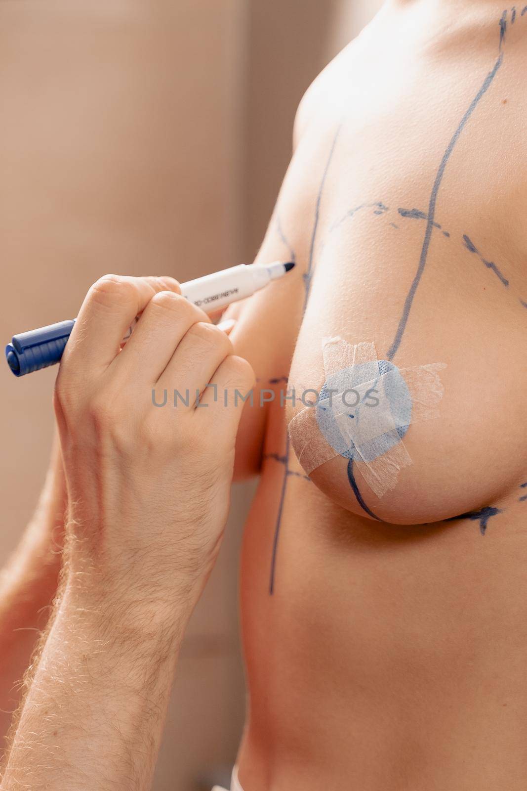 Breast augmentation surgery markup. Preparation for plastic surgery for introduction of silicone implant