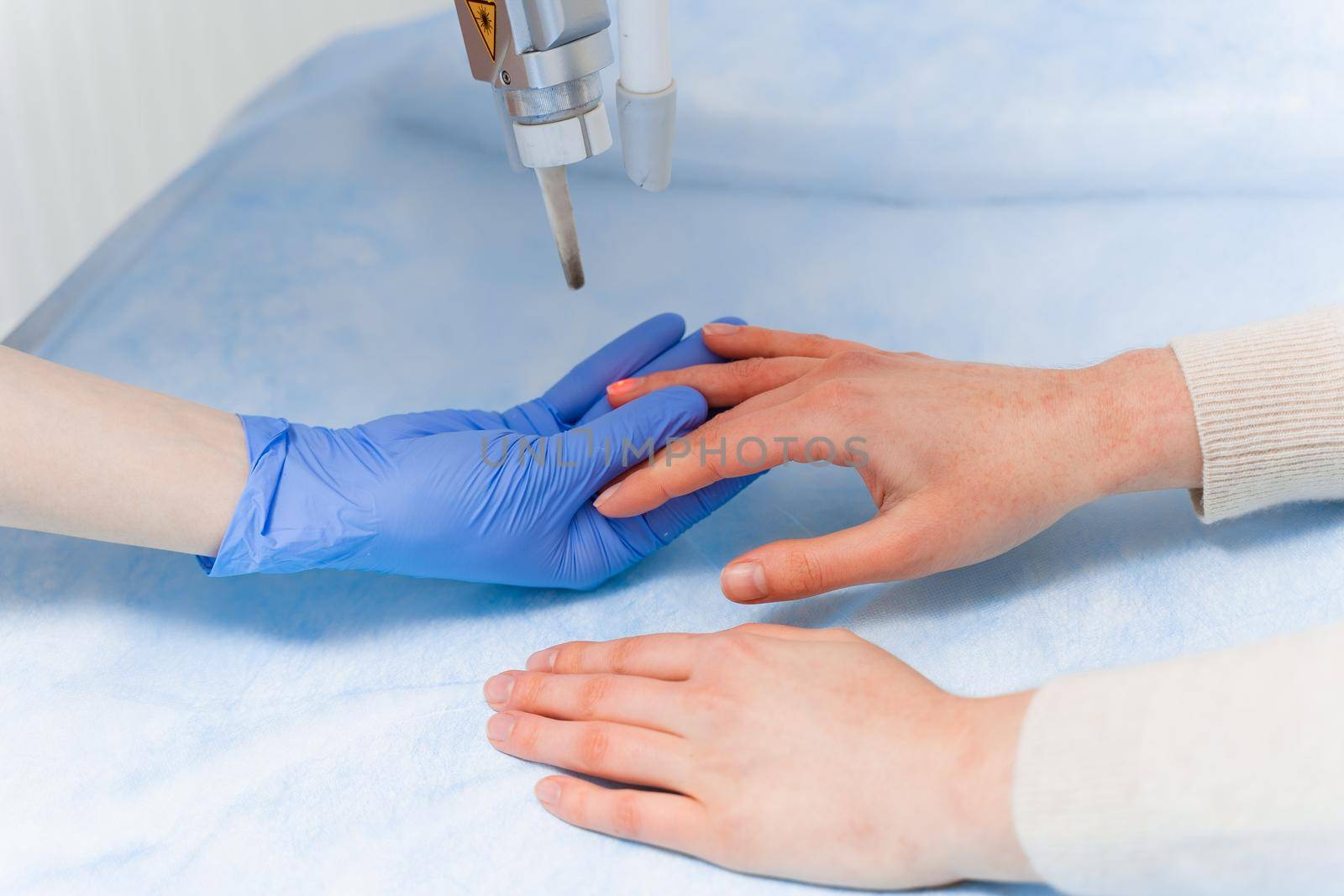 Laser treatment of onychomycosis. fungal infection on the hands of a young girl in medical clinic.