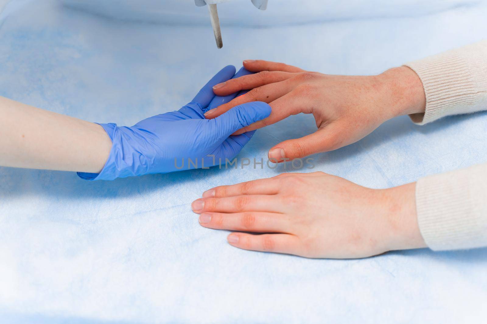 Laser treatment of onychomycosis. fungal infection on the hands of a young girl in medical clinic.