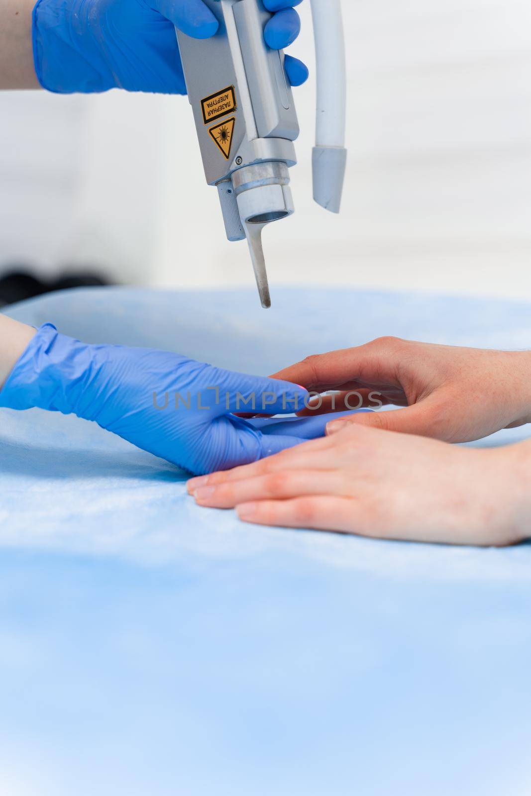 Laser treatment of onychomycosis. fungal infection on the hands of a young girl in medical clinic.