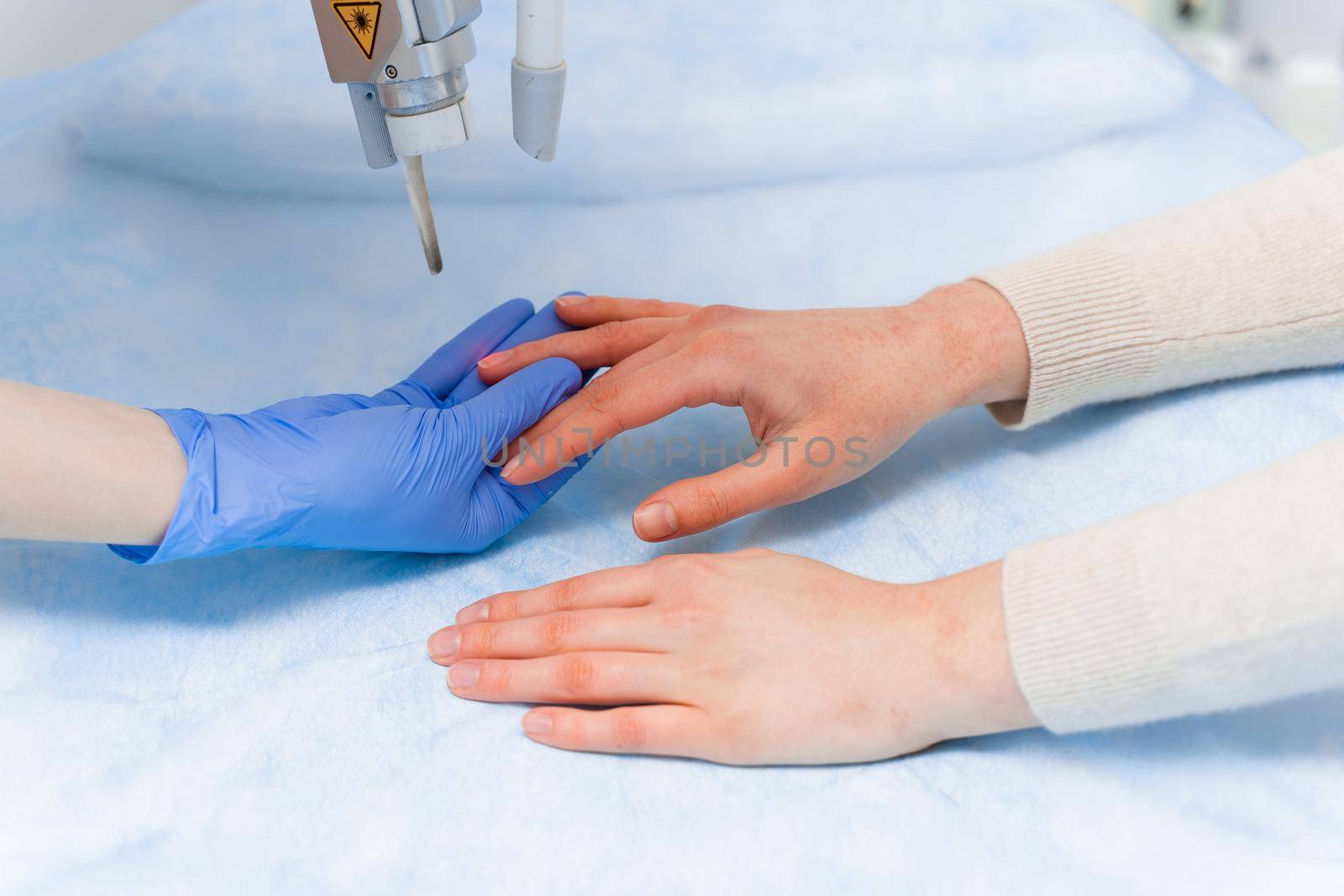 Laser treatment of onychomycosis. fungal infection on the hands of a young girl in medical clinic.