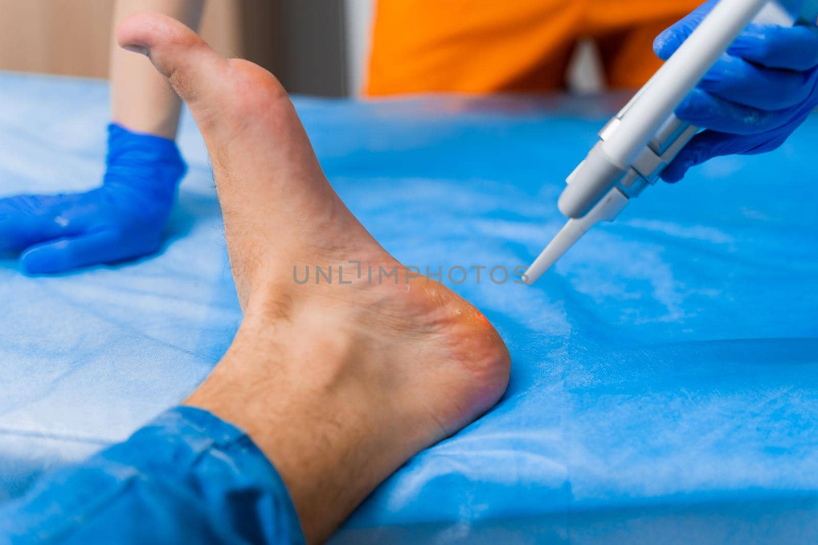 Laser removal of warts on the foot. Medical dermatological surgery in the clinic.