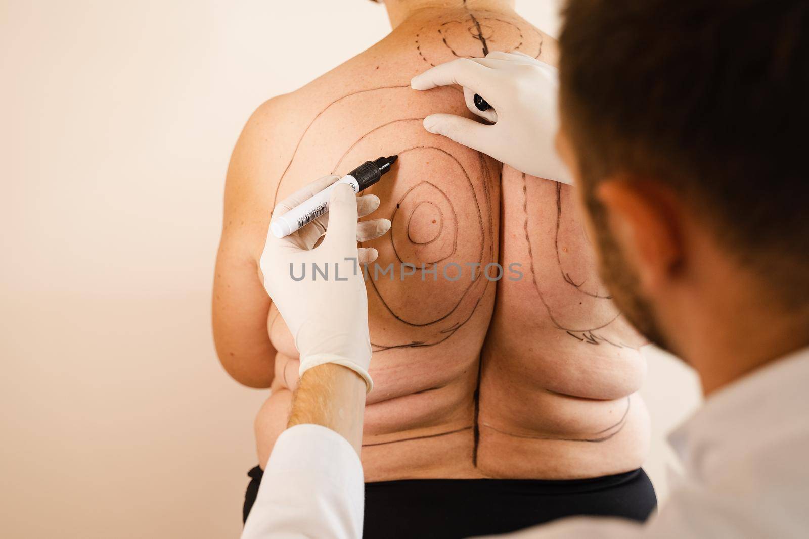 Markup for liposuction surgery. Kyphosis. Removing dowager hump. Obesity of woman