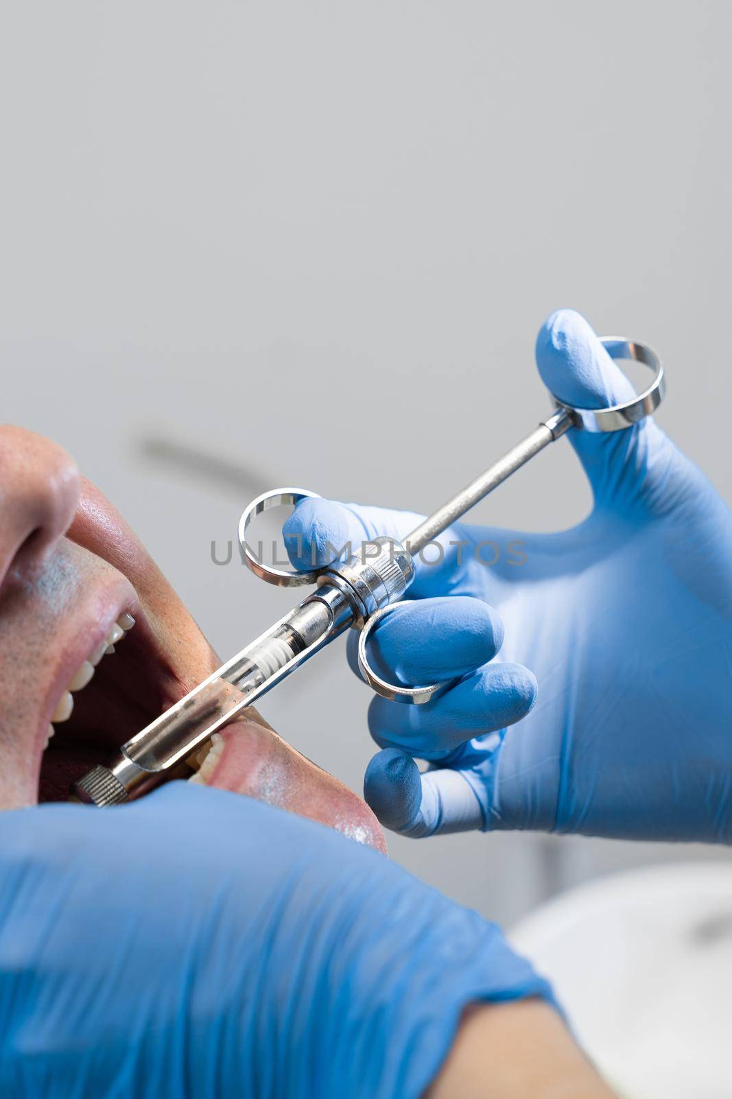 Dentist injects anesthesia syringe of the diseased teeth for the patient. Caries treatment