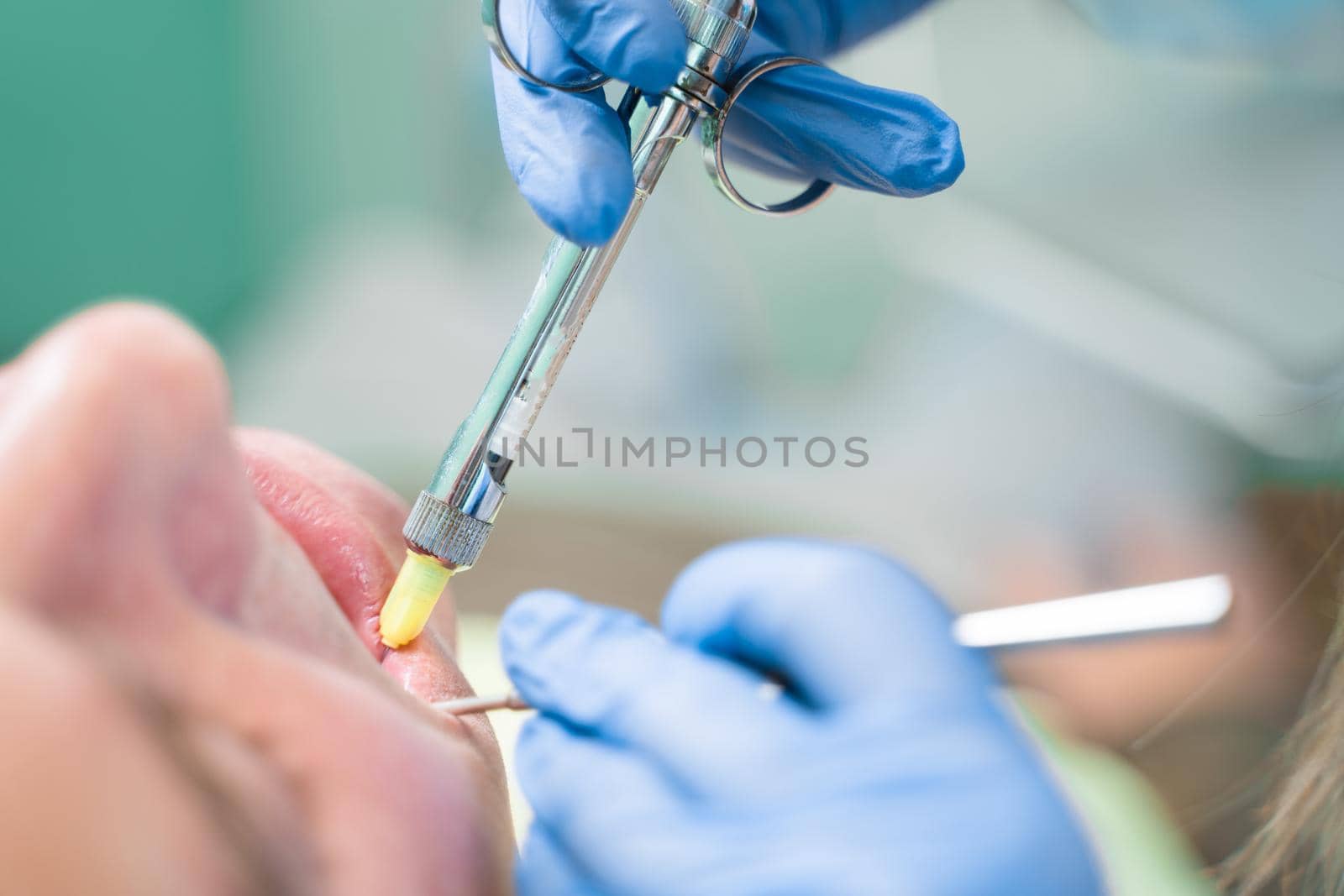 Dentist injects anesthesia syringe of the diseased teeth for the patient. Caries treatment. by Rabizo