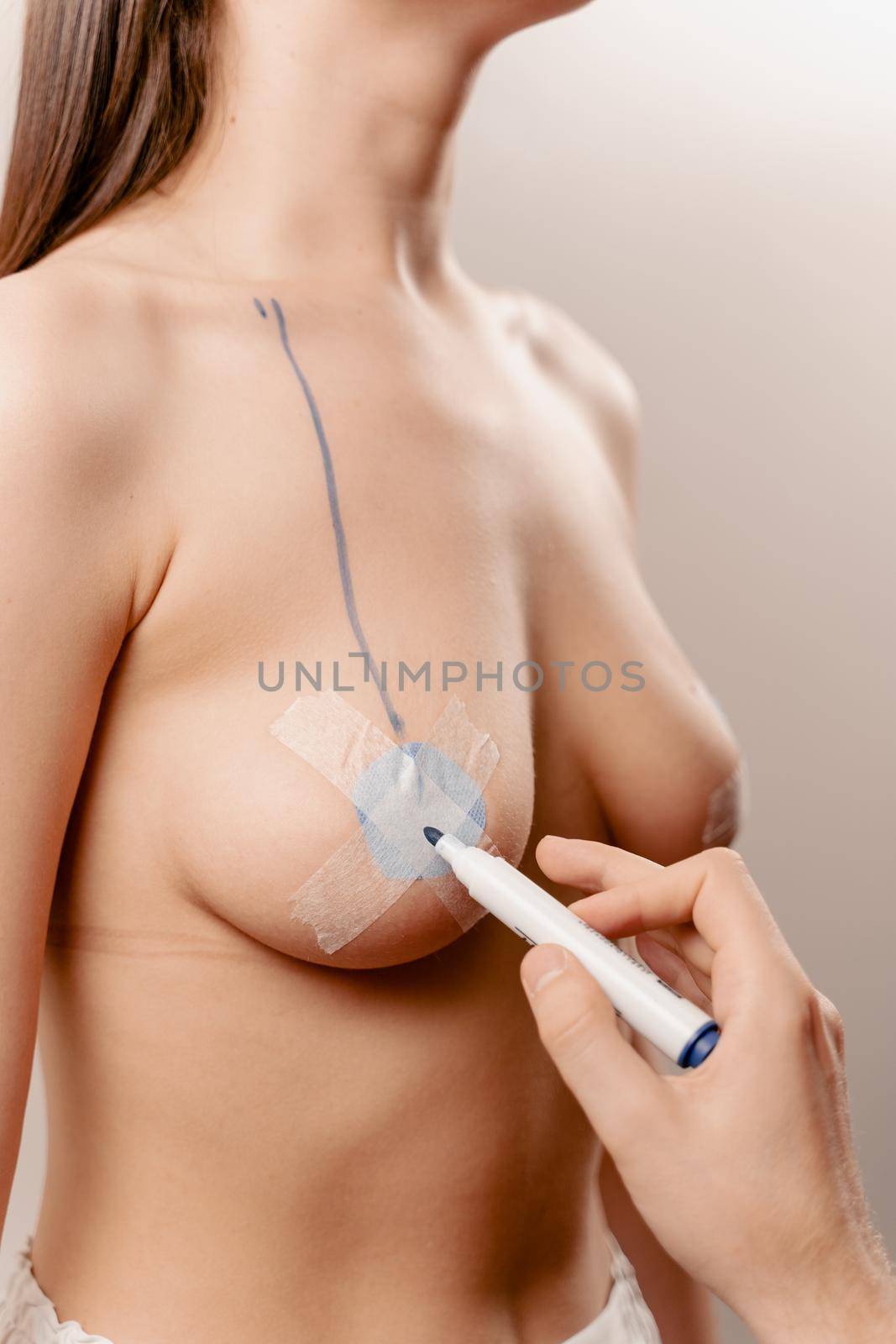 Breast augmentation surgery markup. Preparation for plastic surgery for introduction of silicone implant