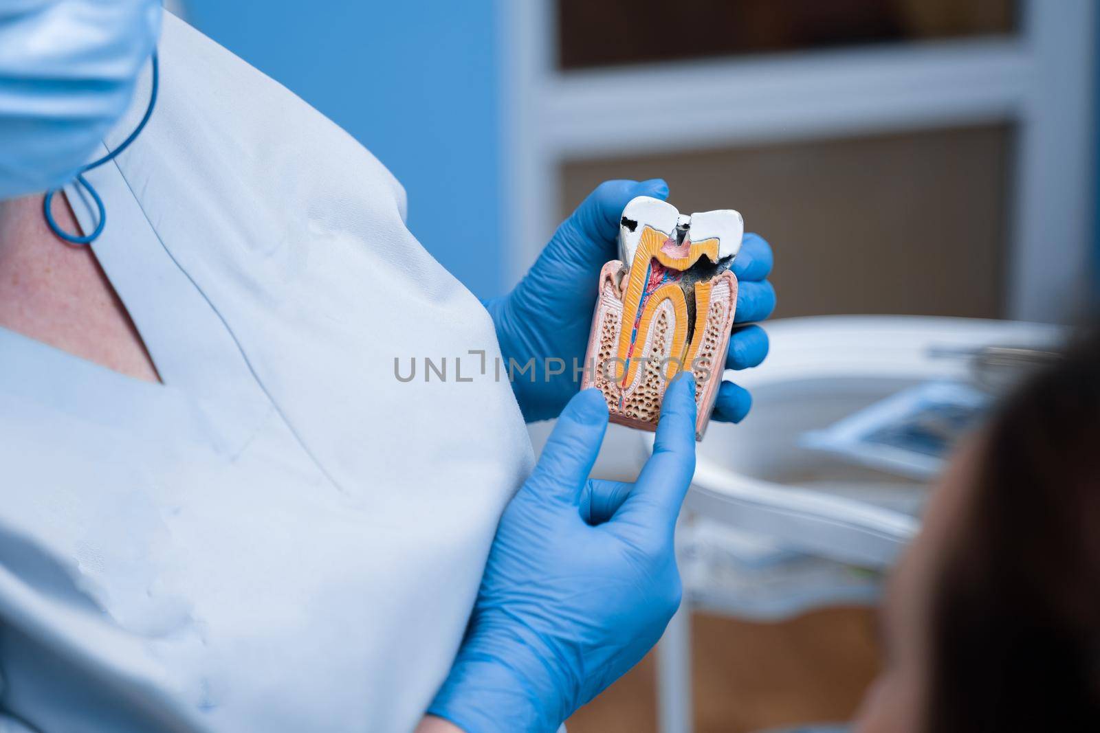 Dummy of a sick tooth with caries, Dentist shows structure of the teeth