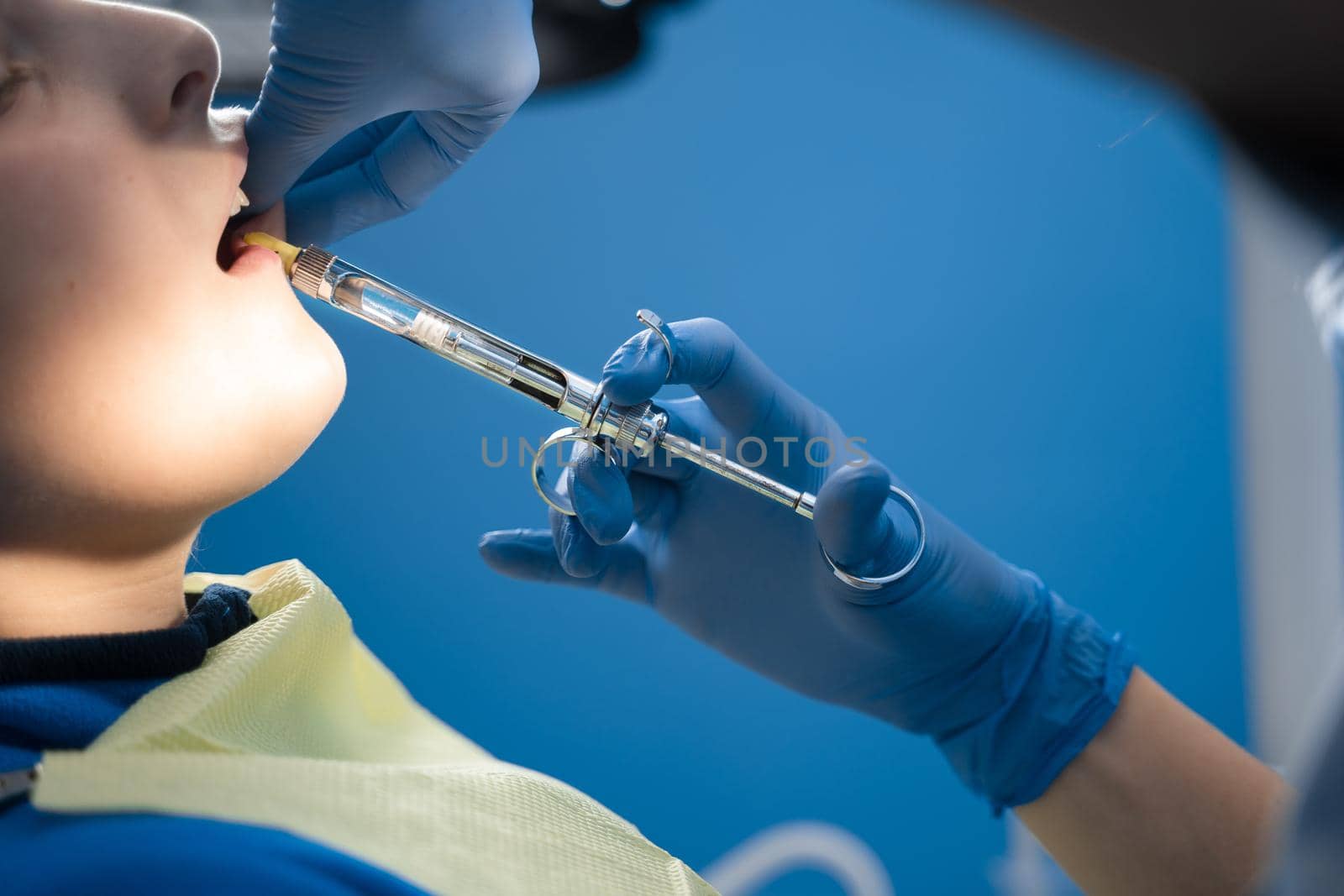 Dentist injects anesthesia syringe of the diseased teeth for the patient. Caries treatment