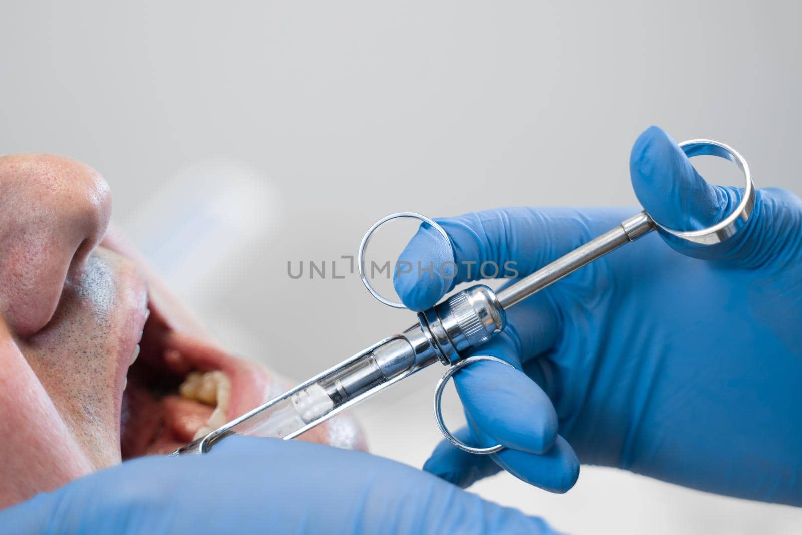 Dentist injects anesthesia syringe of the diseased teeth for the patient. Caries treatment