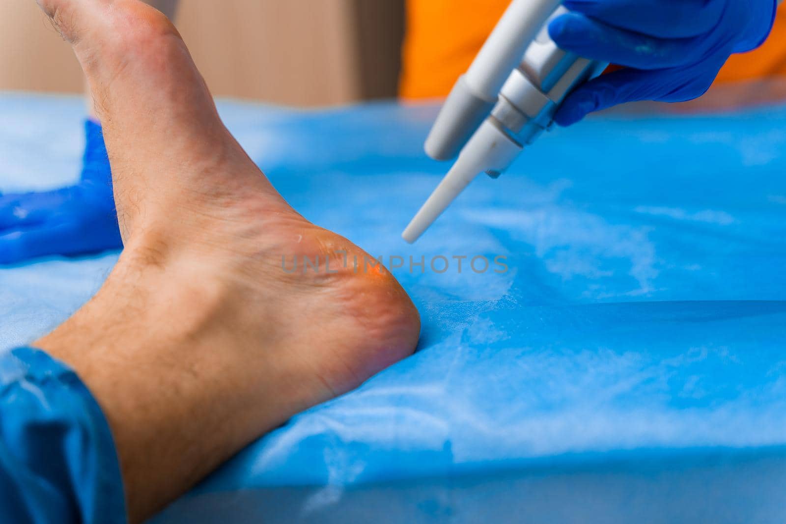 Laser removal of warts on the foot. Medical dermatological surgery in the clinic.