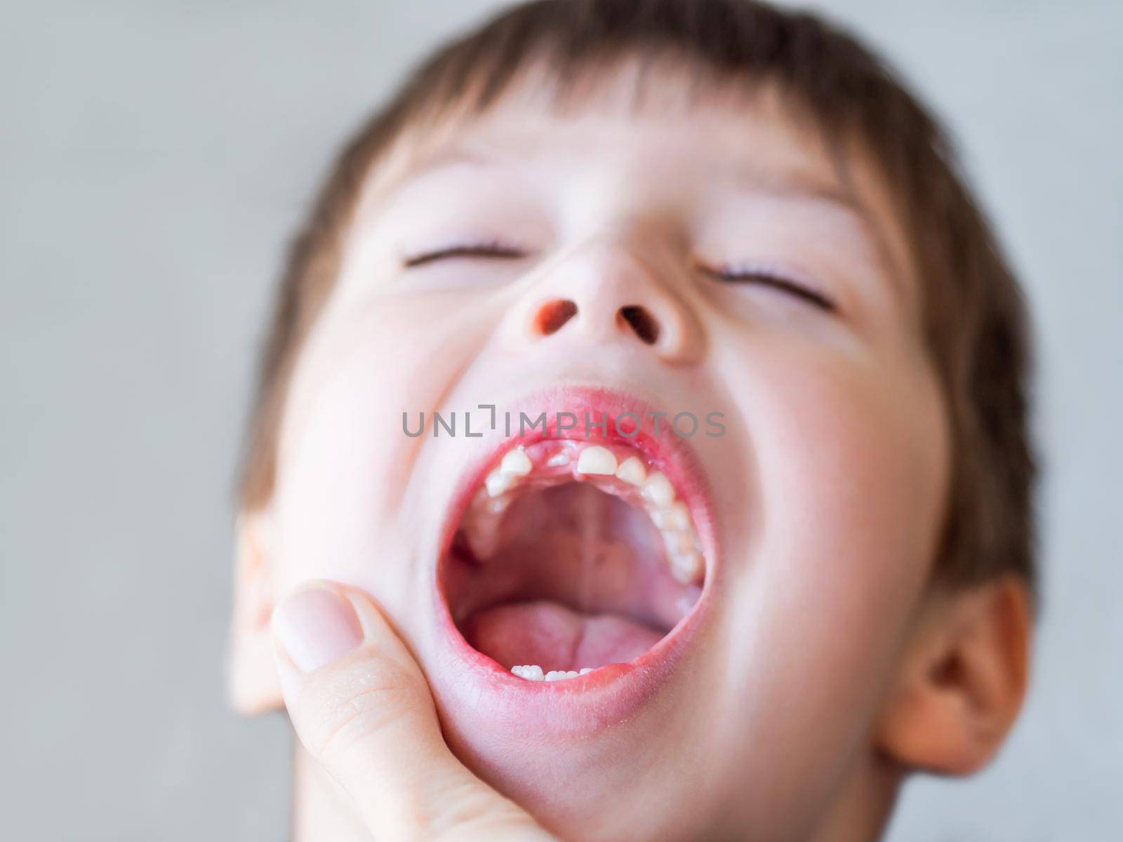 Kid shows hole in row of teeth in his mouth. One incisor fell out just now. Close up photo of gums for dentist.