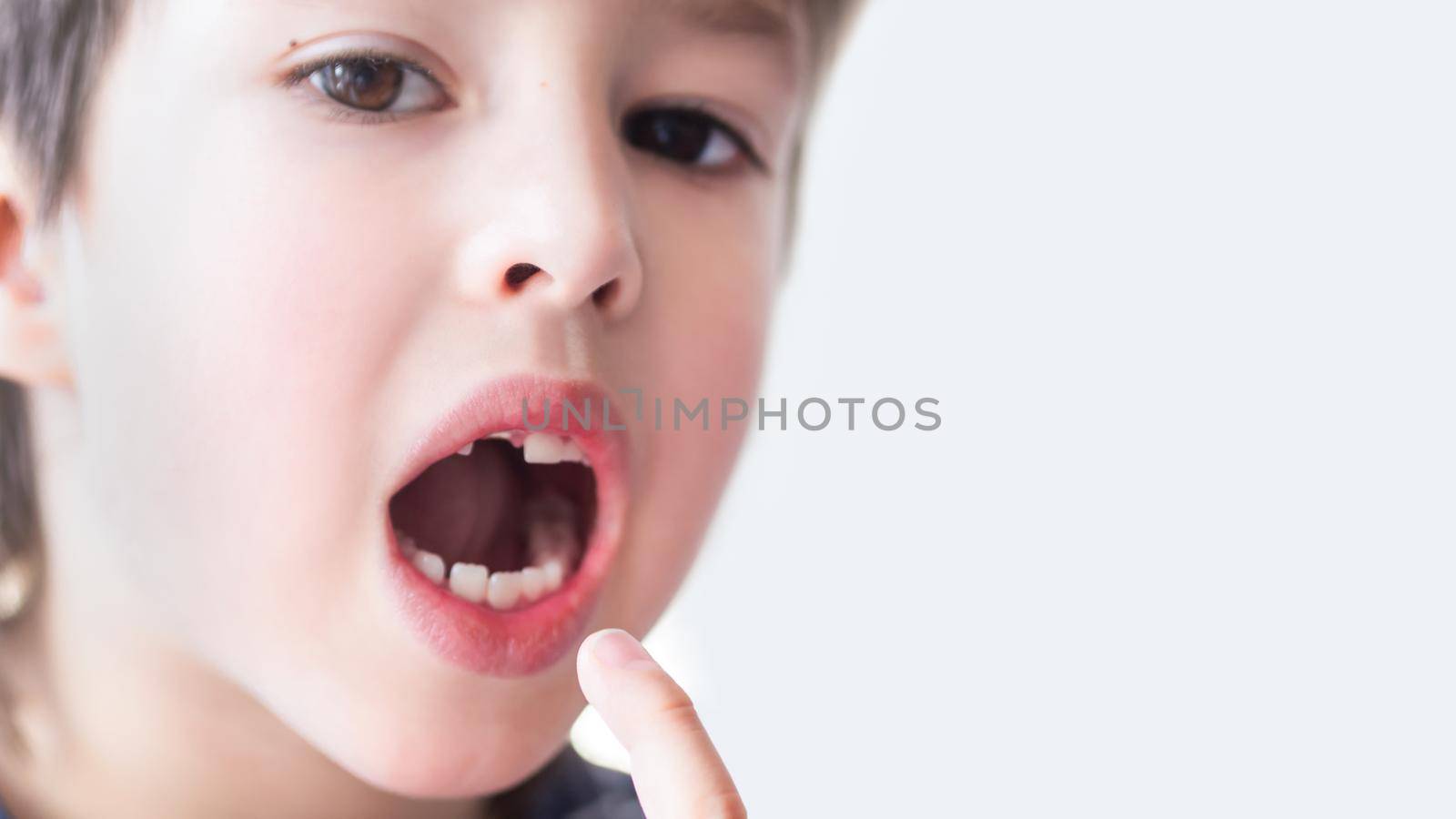 Smiling kid shows hole in row of teeth in his mouth. One incisor fell out just now. Close up photo of gums for dentist. Copy space.