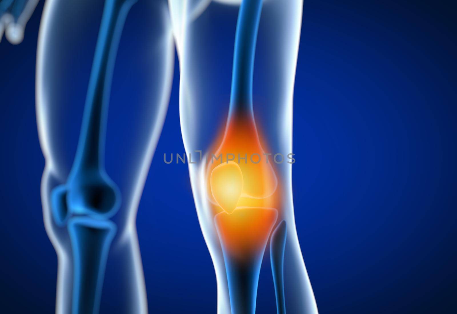 3d rendered illustration of a painful knee by cla78