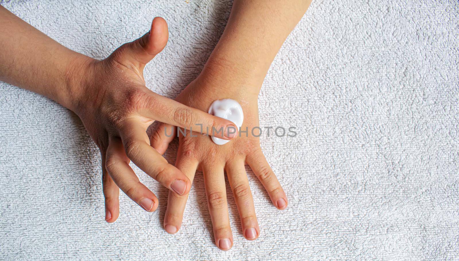 Red spots on the skin of the child's hands.children's allergy.selective focus.nature