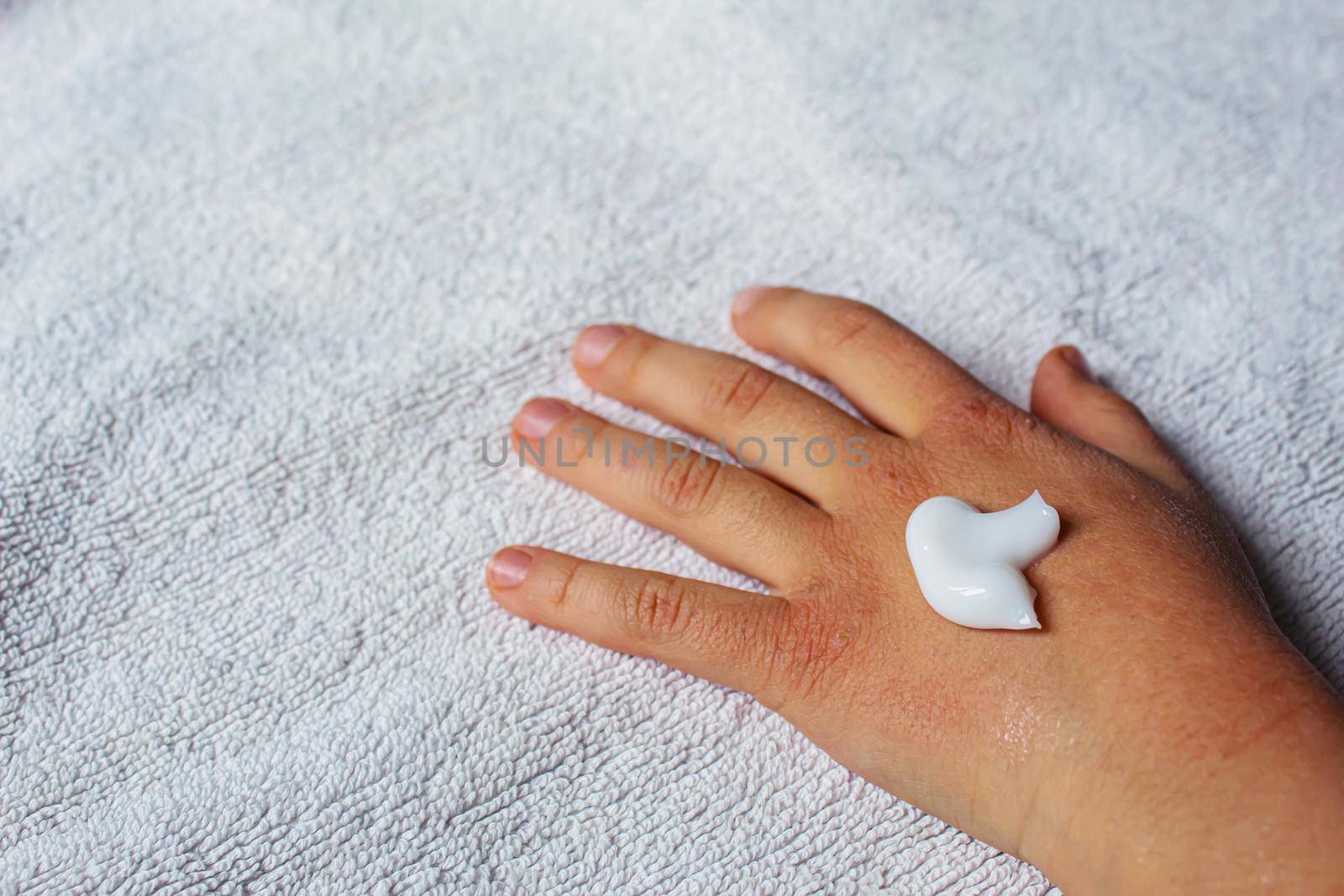 Red spots on the skin of the child's hands.children's allergy.selective focus.nature