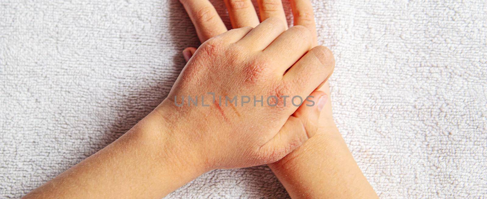 Red spots on the skin of the child's hands.children's allergy.selective focus.nature