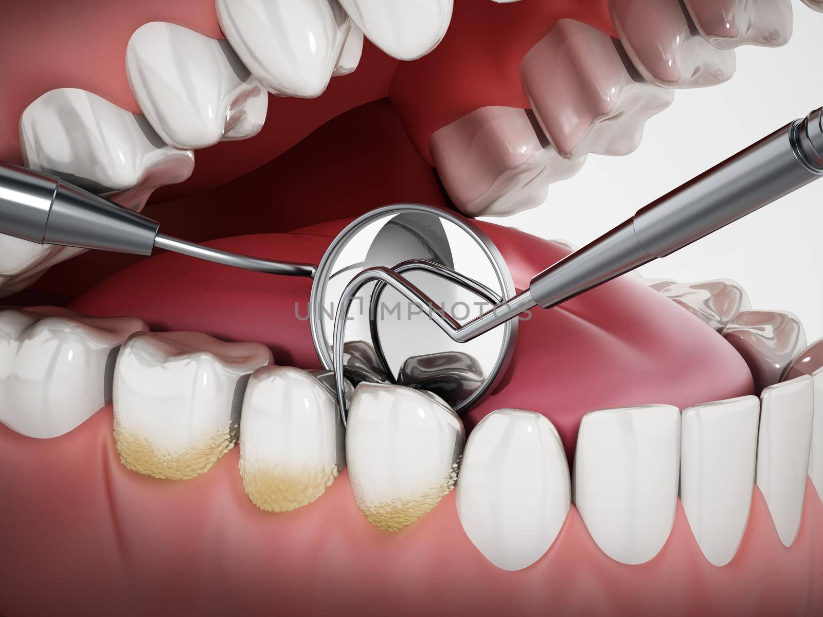3D illustration showing dentist tools and dental plaque on model. 3D illustration by Simsek