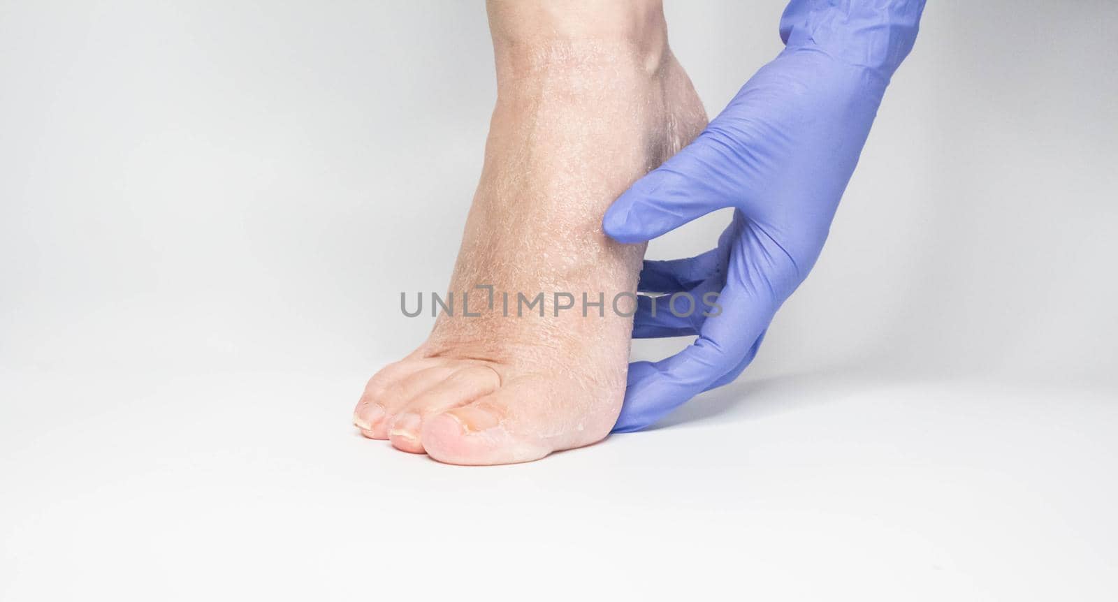 Doctor examines the patient's leg in blue gloves. The heel is all blistered and cracked. close-up.