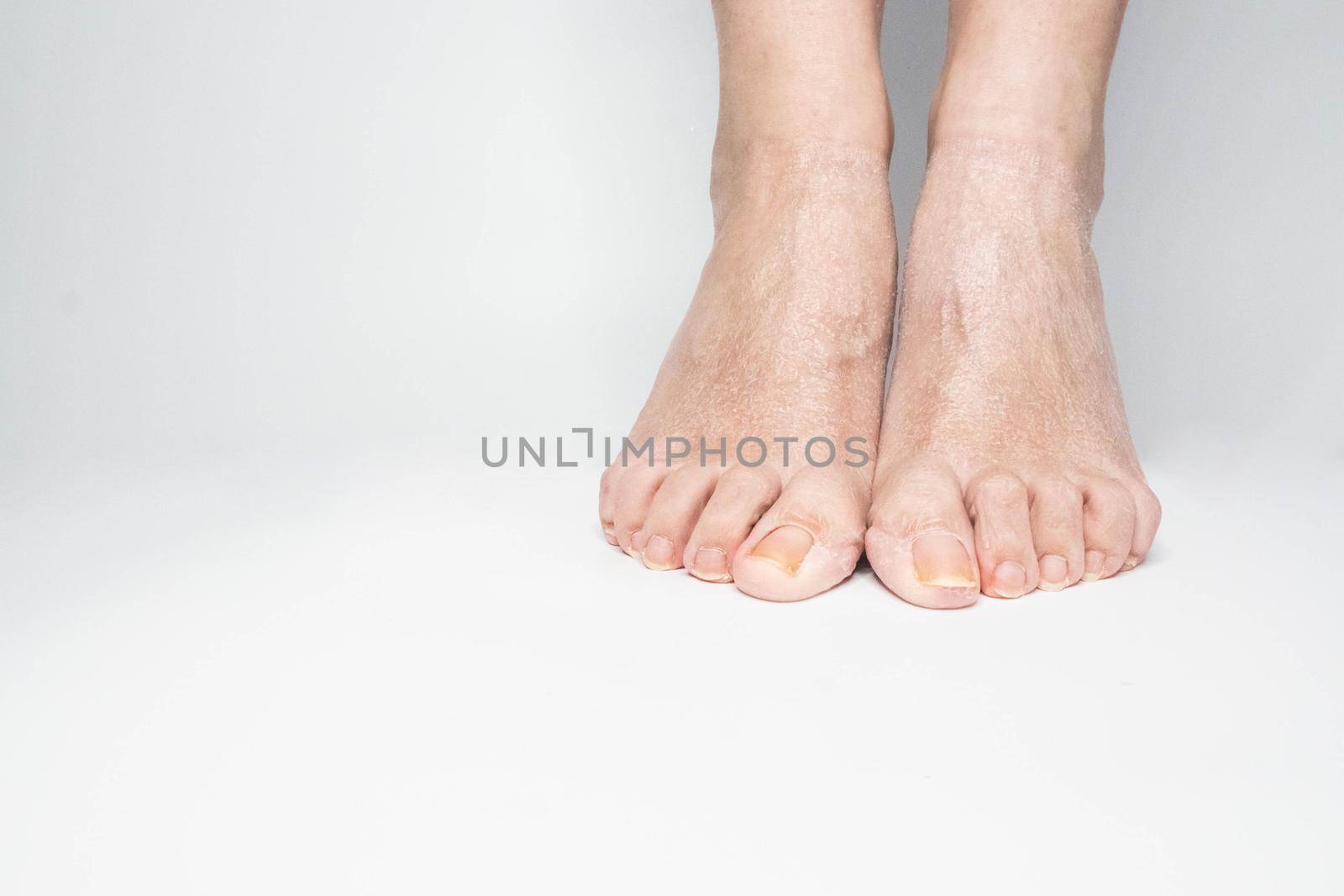 Close-up view female sore skin of feet, dry heels isolated on a white background