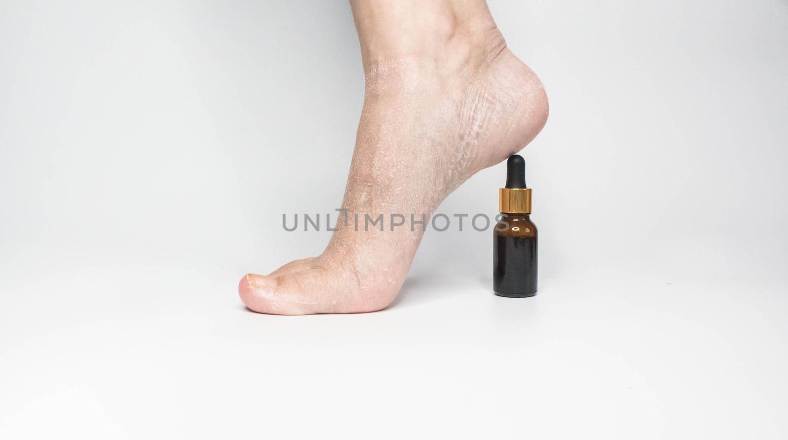 Feet with dry skin before oil treatment. Woman foot with an esential oil bottle as a heel. White background