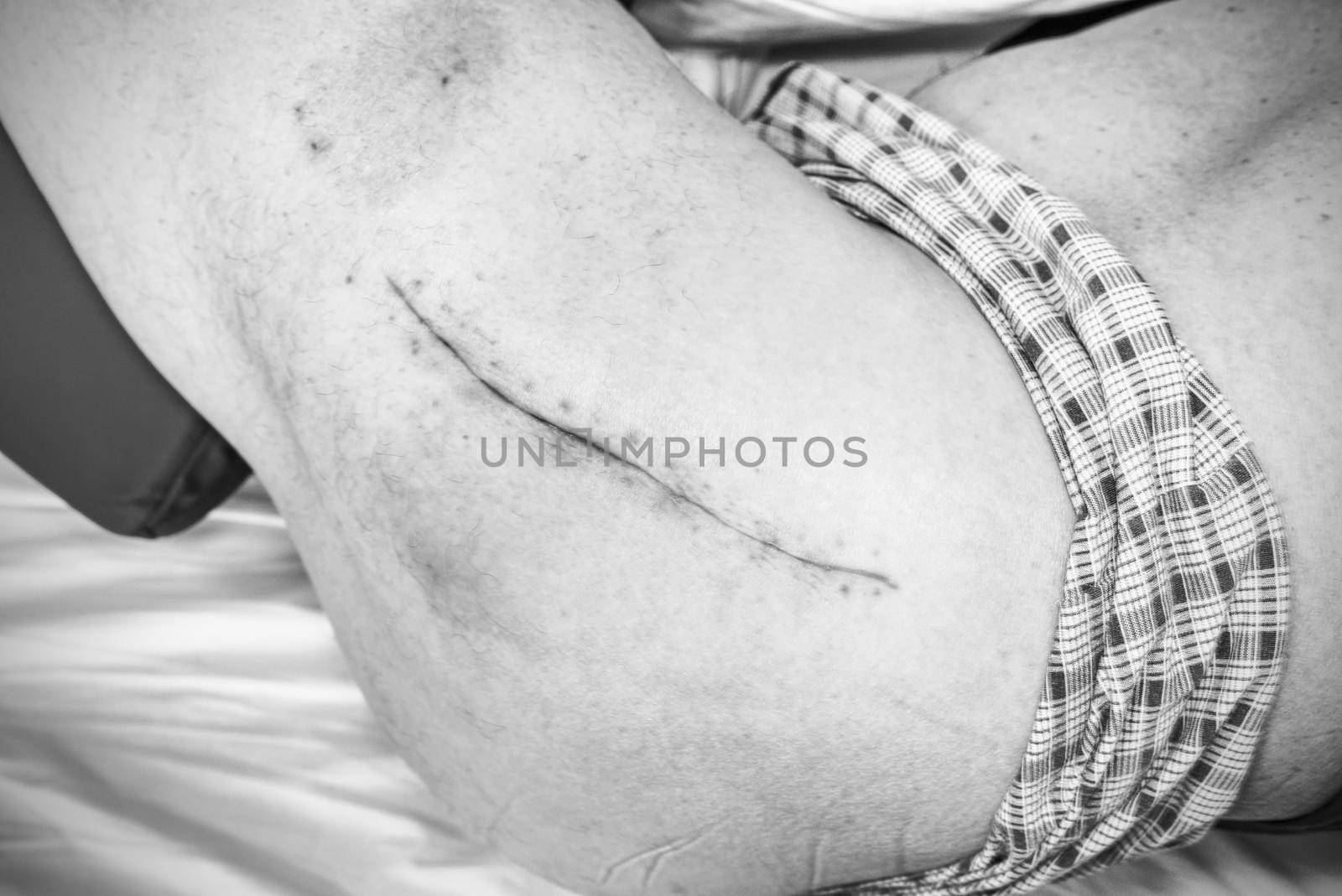 Patient month after surgery, long scar on hip. Control of healing, clear the skin. Hospital health care