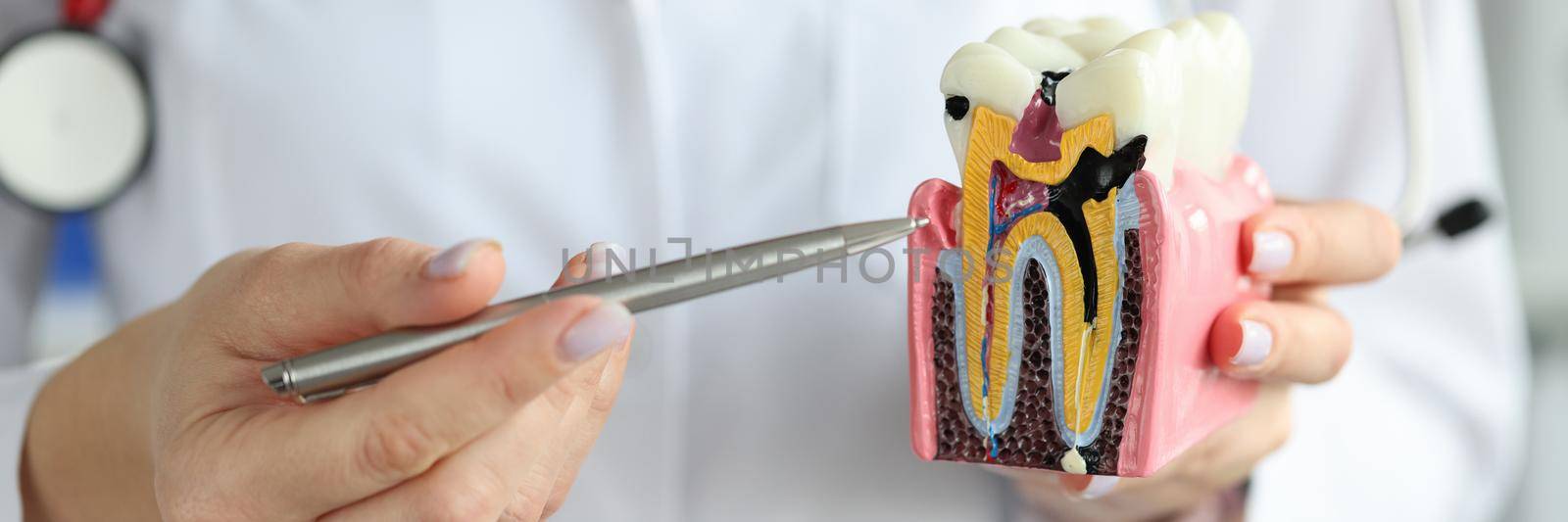 Doctor showing carious cavity with ballpoint pen on plastic artificial tooth model closeup. Dental care concept