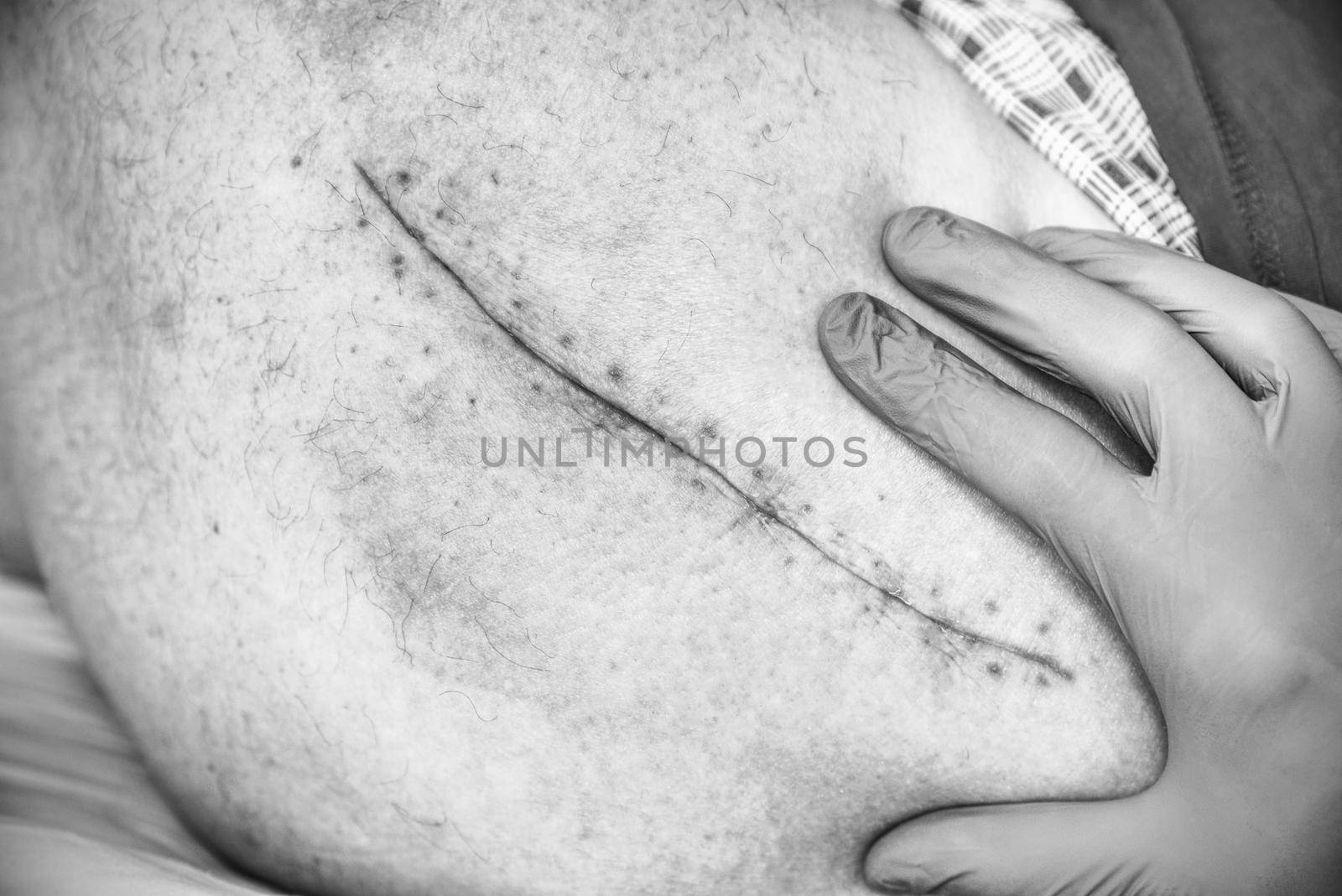 Old Human leg with postoperative scar of hip joint surgery. Selective focus of male body. by rdonar2