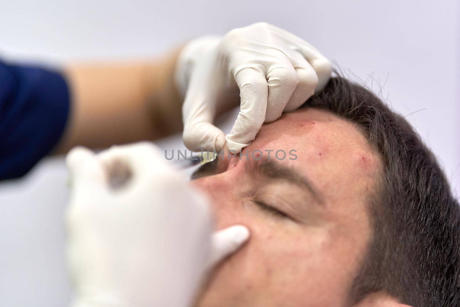 Doctor pinching a piece of skin where he injects botox for a patient's facial rejuvenation treatment