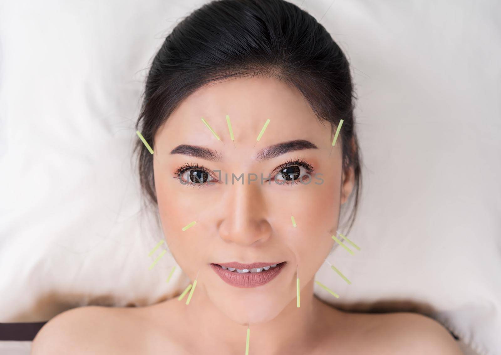 woman undergoing acupuncture treatment on face by geargodz