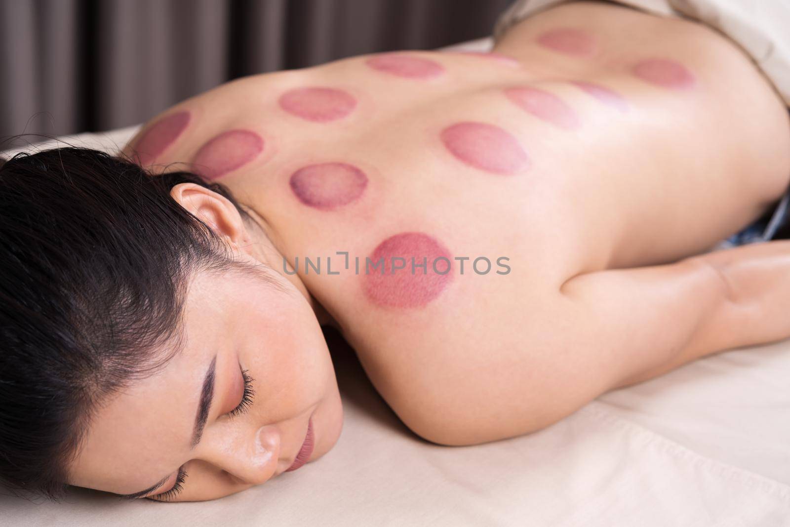 woman receiving cupping treatment on back by geargodz