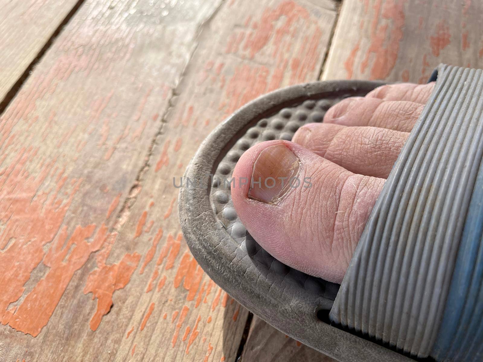 Fungus-damaged nails on the right foot