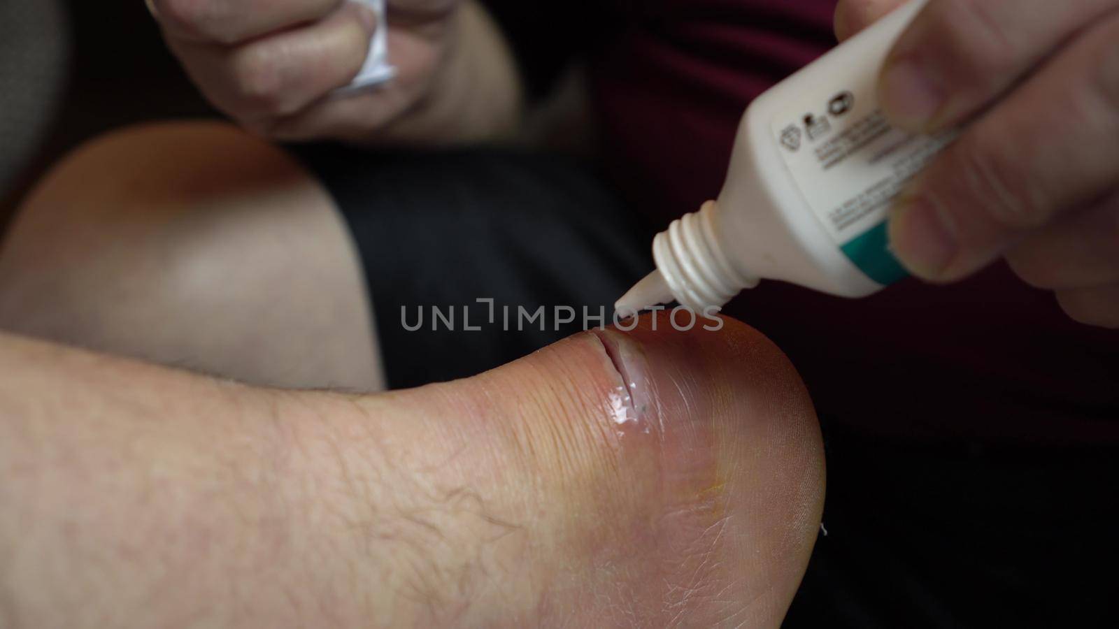 Treating a leg wound with an antiseptic. Operational incision of the ankle due to inflammation. 4k