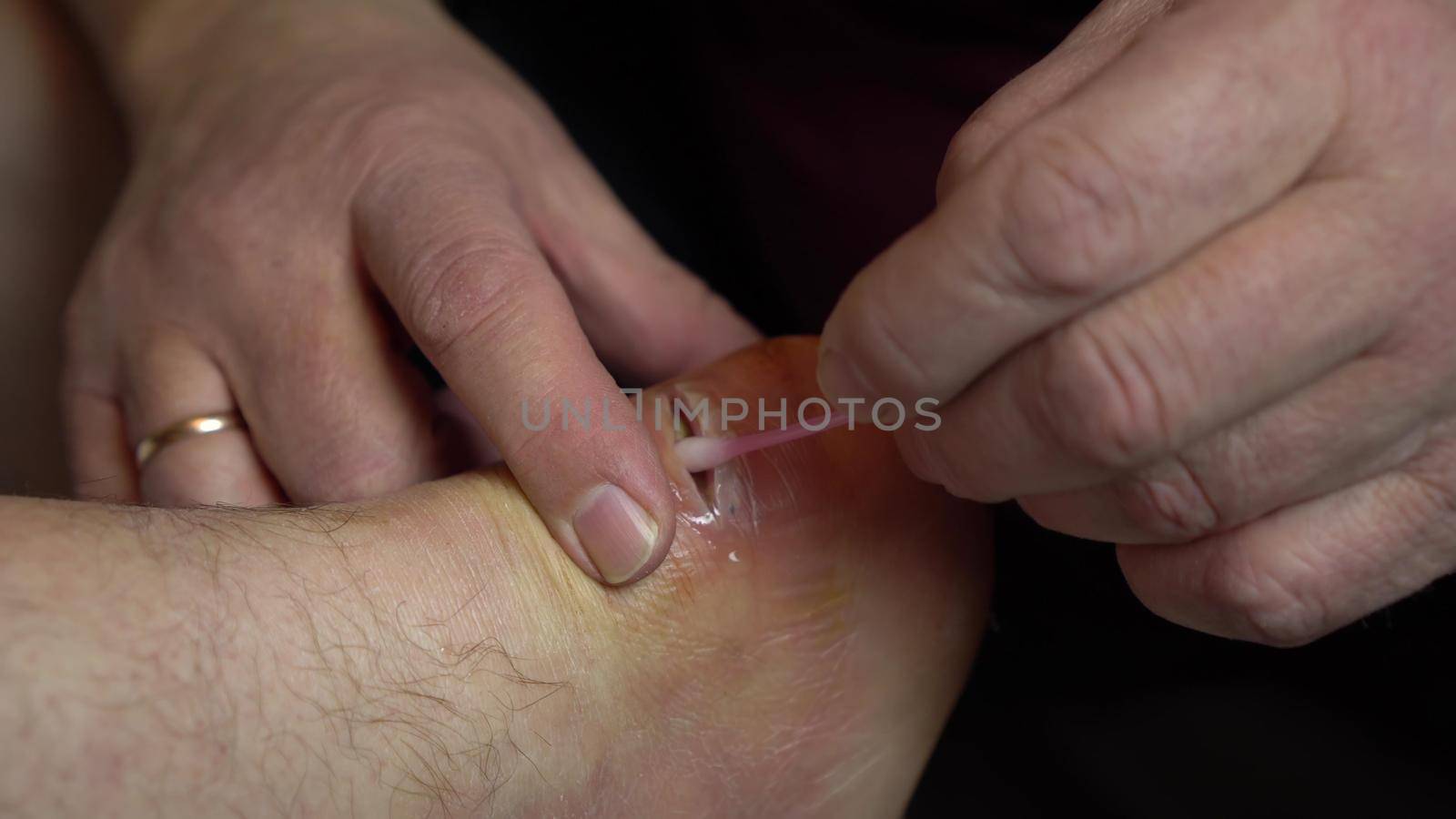 Wound treatment from suppuration with a cotton swab. Surgical incision of the ankle joint for inflammation. 4k