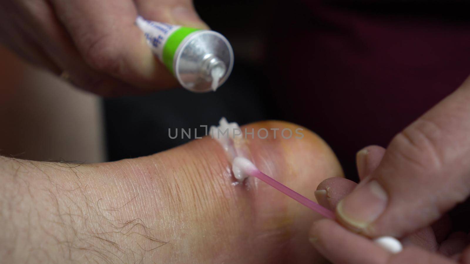 Application of ointment to heal a wound on the leg. Surgical incision of the ankle joint for inflammation. 4k