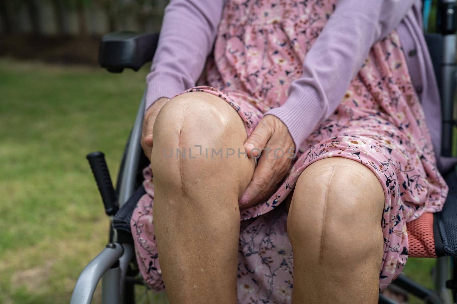 Asian senior or elderly old lady woman patient show her scars surgical total knee joint replacement Suture wound surgery arthroplasty on bed in nursing hospital ward, healthy strong medical concept.