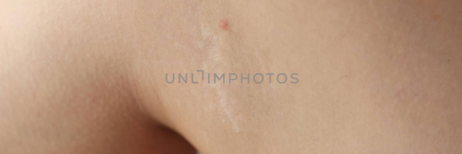 An inflamed pimple on the leg, close-up, shugaring. Skin irritation, dermatologist visit, problem skin