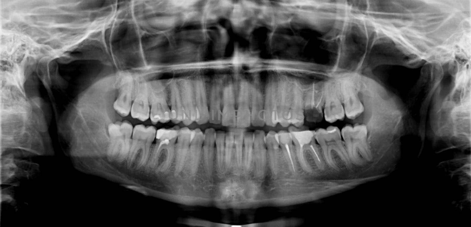 Original black white x-ray teeth scan mandible. Panoramic negative image facial of young adult male. Photo was taken on digital system equipment for dental diagnostic examination upon clinical checkup