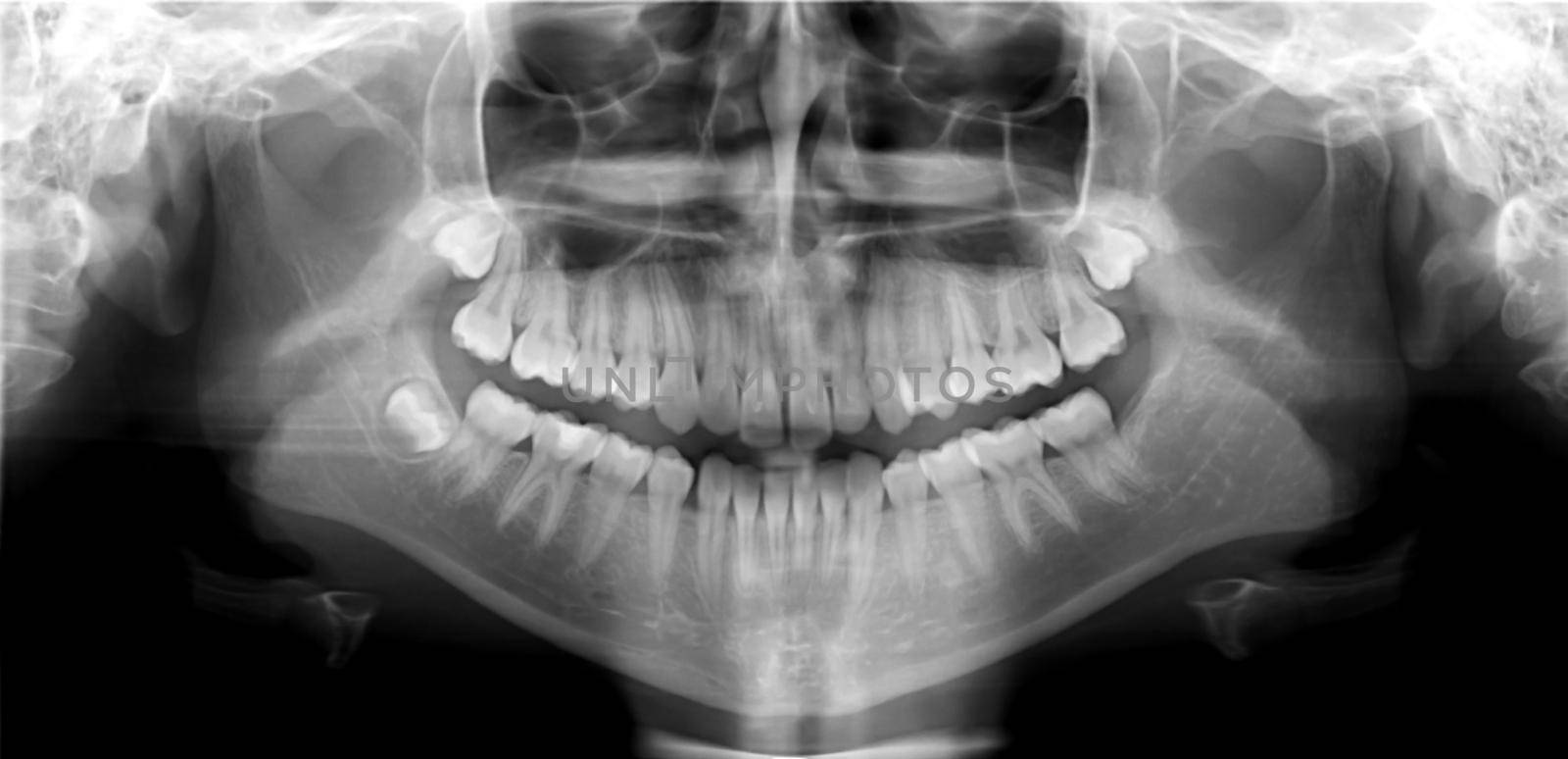 Original black white x-ray teeth scan mandible. Panoramic negative image facial of young adult male. Photo was taken on digital system equipment for dental diagnostic examination upon clinical checkup