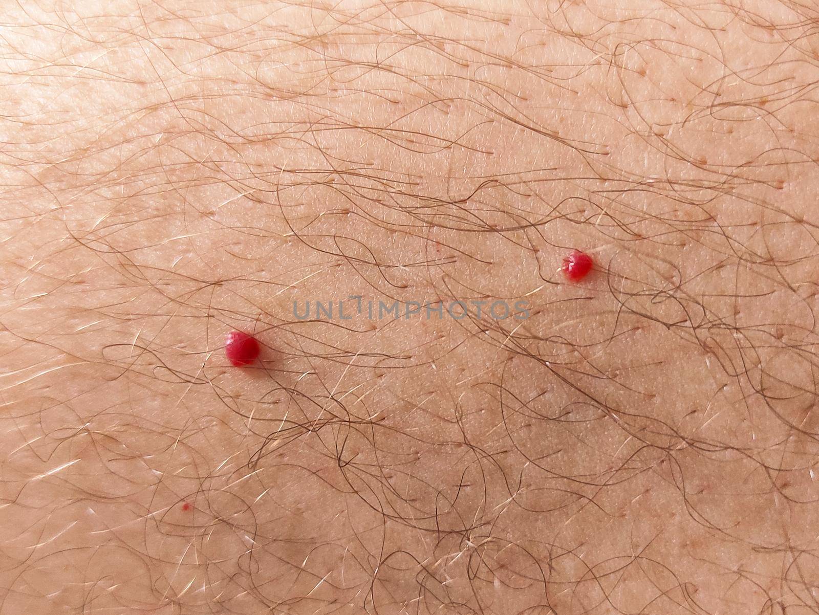 Close up photo of cherry angioma on human skin by clusterx